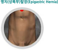 명치(상복부)탈장(Epigastric Hernia)