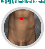 배꼽탈장(Umbilical Hernia)