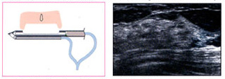 유방검사기 시술원리 2