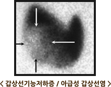 갑상선기능저하증 / 아급성 갑상선염