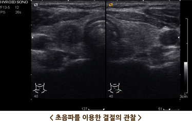 초음파를 이용한 결절의 관찰