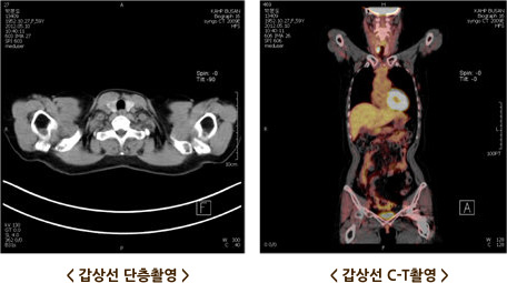 초음파를 이용한 결절의 관찰