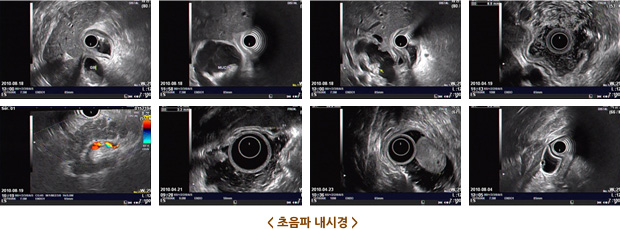 초음파 내시경